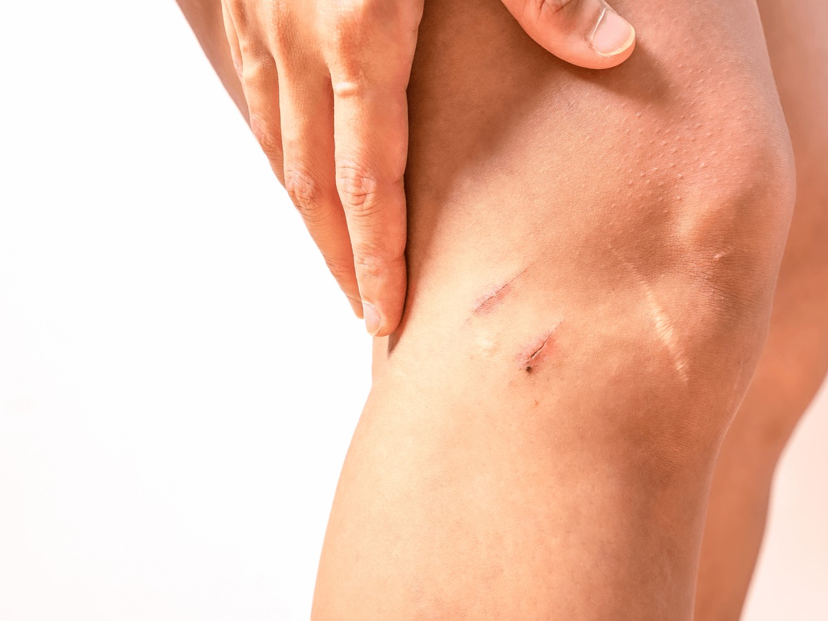 【傷跡が気になる男性必見】傷跡を治す方法とは？目立たなくする方法や予防法のサムネイル